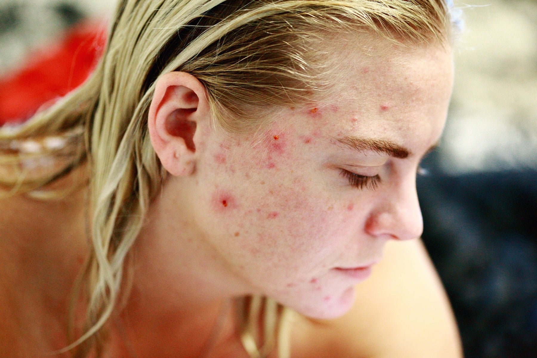 Blonde woman struggling with acne looking down